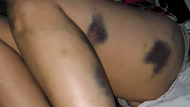 San Carlos. Las lesiones sufridas por la víctima, quien permanece internada.
