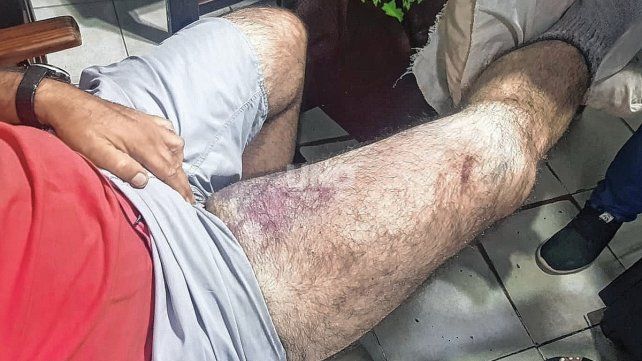Las marcas tras el taque que sufrió Mario en la noche del jueves en barrio Mariano Comas.