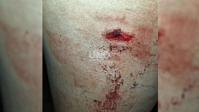 La herida de bala en la pierna del jugador